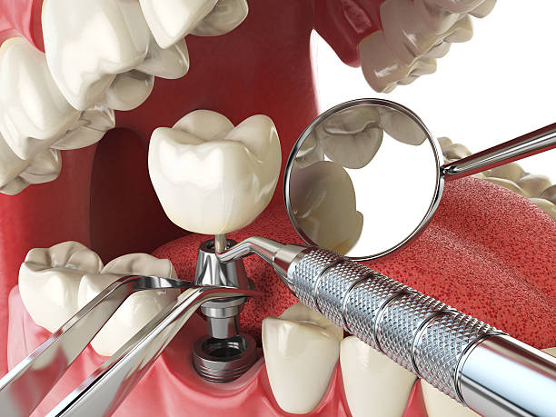 Best Emergency Treatment for Dental Infections or Abscesses in Mart, TX